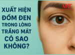 XUẤT HIỆN ĐỐM ĐEN TRONG LỒNG TRẮNG MẮT CÓ SAO KHÔNG?
